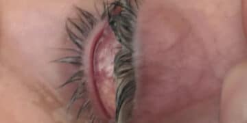 Cagliari, grave infezione all’occhio e nessuna assistenza nel weekend: “Salvata da dottor Cau”