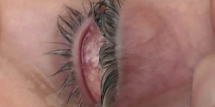 Cagliari, grave infezione all’occhio e nessuna assistenza nel weekend: “Salvata da dottor Cau”