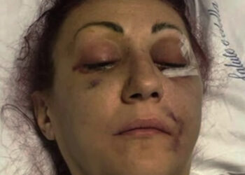 Lucia Regna picchiata dal marito e con il volto distrutto, il giudice: “Va compreso, sfaldato matrimonio ventennale”