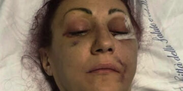 Lucia Regna picchiata dal marito e con il volto distrutto, il giudice: “Va compreso, sfaldato matrimonio ventennale”