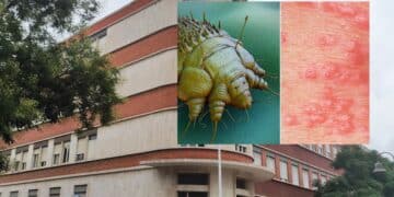 Cagliari, casi di scabbia all’istituto superiore: le rassicurazioni della scuola non bastano