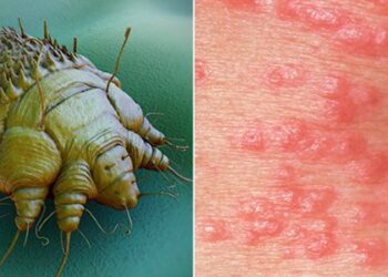 Cagliari, due casi di scabbia all’istituto Eleonora d’Arborea